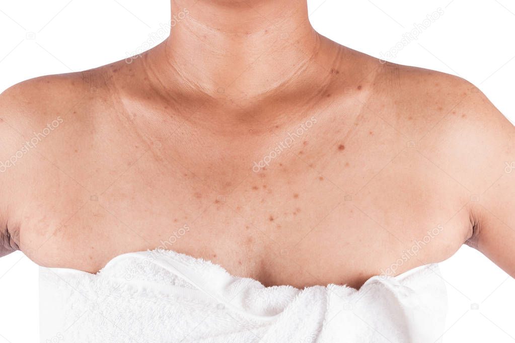 acne on body skin on white background
