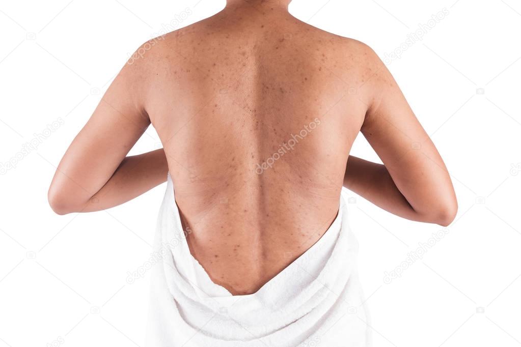 acne on body skin on white background
