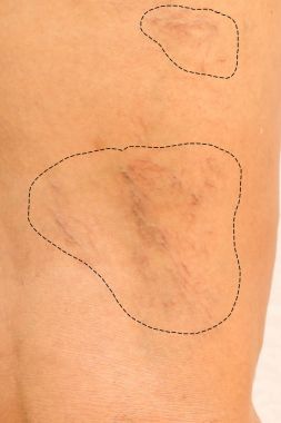 varicose veins on leg women clipart