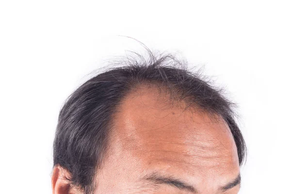 Bald head of young man — Stock Photo, Image