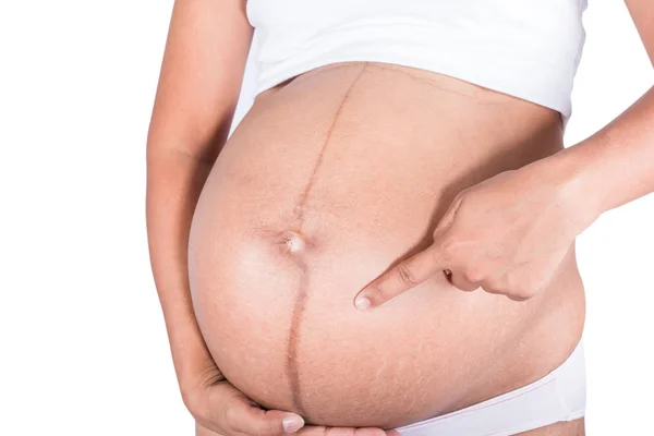 Linea nigra et vergetures sur les femmes enceintes — Photo