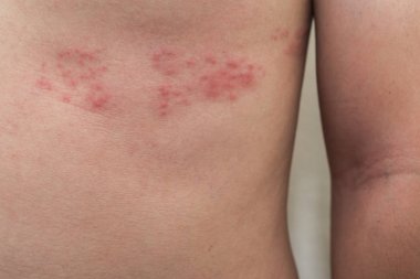 Herpes Zoster (Zona ile vücut cilt detay)