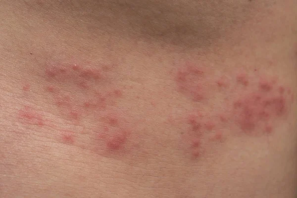 Closeup of body skin with Herpes Zoster (Shingles) — Stock Photo, Image