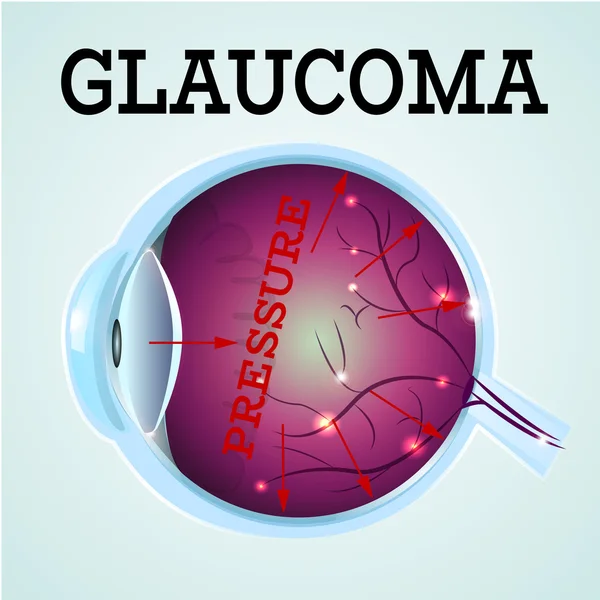 Глаукома здорового глаза — стоковый вектор