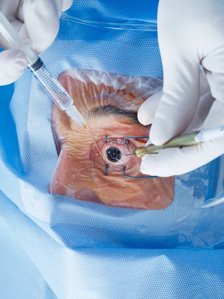 Chirurgia dell'occhio primo piano — Foto Stock