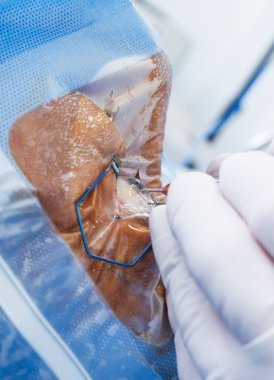 Göz cerrahisi yakın çekim