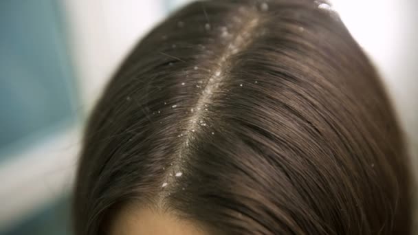 Перхоть на женских волосах — стоковое видео