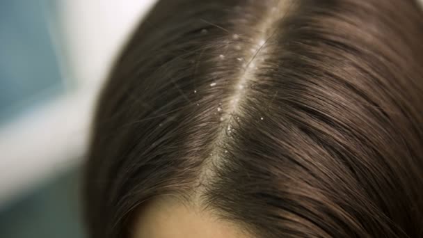 Перхоть исчезает из женских волос — стоковое видео