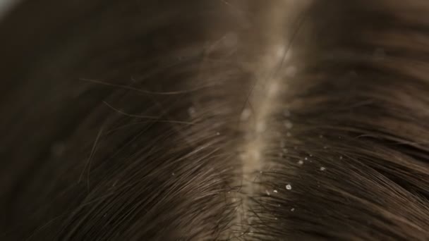 Πιτυρίδα σε famale σκούρα μαλλιά — Αρχείο Βίντεο