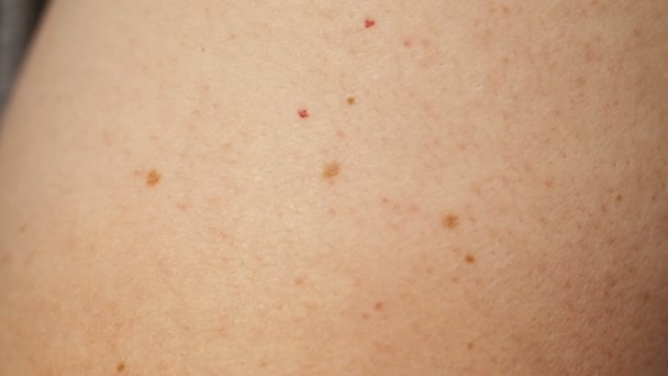 Skin with a lot of moles — Stock Video