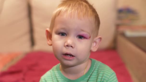 Niño pequeño con un ojo morado — Vídeo de stock