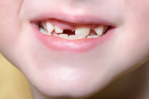 Child's smiling mouth with milk teeth. Some teeth are lost and there are gaps between other. — Stock Photo, Image