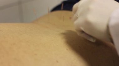 Akupunktur. Doktor iğne kullanarak bir hasta muamelesi yapıyor.