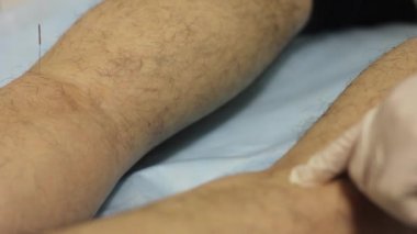 Akupunktur. Doktor hastaların vücut iğne ayarlar.