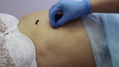 Hirudotherapy. Doktor sülük hasta karnına ayarlar.