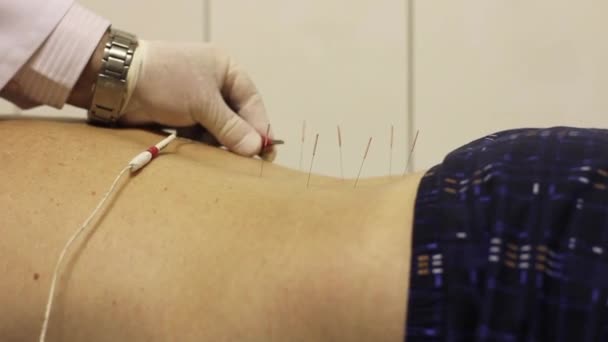 Электроиглотерапия. лечение иглоукалыванием с помощью тока — стоковое видео