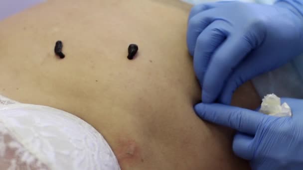 La procédure hirudothérapie, traitement avec des sangsues — Video