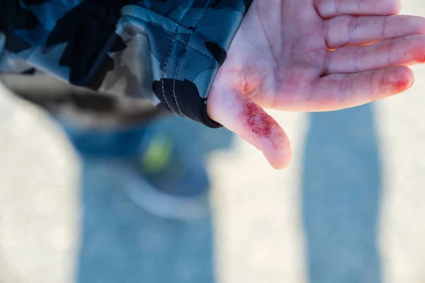 The childs finger blood cut or wound — Stock Photo, Image