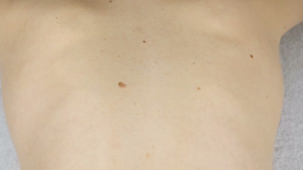 Womans white skin in back with moles. View top. Camera movement from right to left. Close up back. — Stock Video