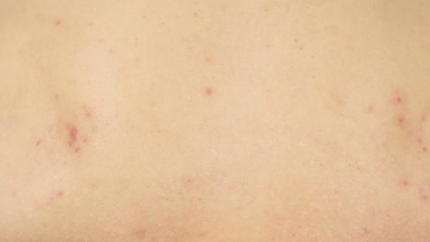 Witte en rode puistjes en acne op de witte huid, uitzicht top. — Stockvideo