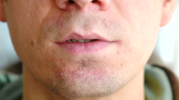 Irritación de la piel después del afeitado. Espinillas en la barbilla del hombre, primer plano . — Vídeos de Stock