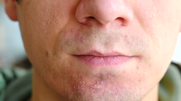 Skin irritation after shaving. Man rubs his hand pimples on his chin closeup. — Stock Video