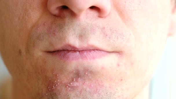 Irritación de la piel después del afeitado. Espinillas en la barbilla del hombre. Primeros planos de nariz, labios y barbilla . — Vídeo de stock