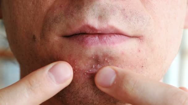 Skin irritation after shaving. Mans hands squeeze pimples on the chin. Closeup chin, lips and nose. — Stock Video