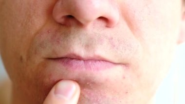 Cilt tahriş tıraş sonra. Adam onun el sivilce onun çene closeup losyonları.