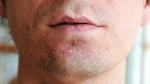 Skin irritation after shaving. Pimples on the mans chin, closeup chin and lips. — Stock Video