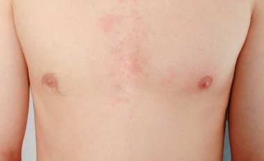 Mens göğüsler yakın çekim. Bir tıraş ve çirkin bir meme ucu.