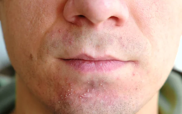 Hud irritation efter rakning på mans hud. Närbild näsa och läppar. — Stockfoto
