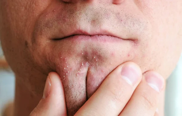 Skin irritation after shaving. Mans hands squeeze pimples on the chin. Closeup chin, lips.