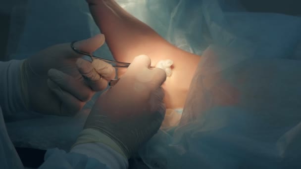 Хирург делает операцию по удалению гигромы лодыжки в больнице в операционной. — стоковое видео