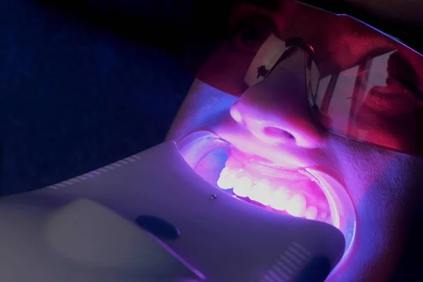 LED procedura cosmetica sbiancante per i denti delle donne in studio di odontoiatria, primo piano . — Foto Stock