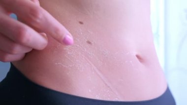 Güneşe çok maruz kaldıktan sonra karın derisini yüzen bir kadın..