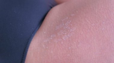 Uv güneş yanığı bacak, closeup görünümü yanmış peeling cilt closeup görünümü.