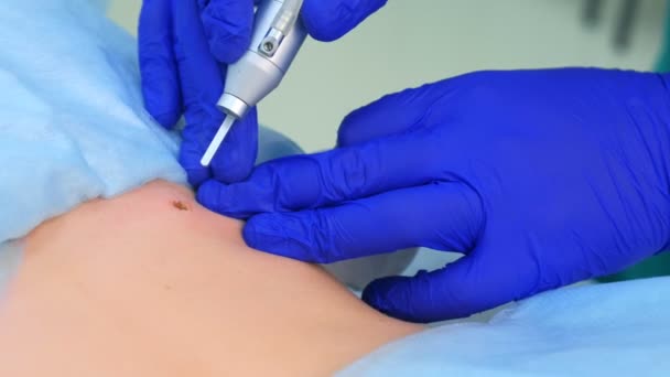 Proceso de extirpación del lunar utilizando láser en la espalda del paciente por el cirujano, vista de primer plano . — Vídeos de Stock