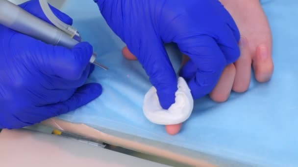 Lazer ışını kullanarak parmaktaki siğilleri çıkaran cerrah operasyonu, ellerin kapanması. — Stok video