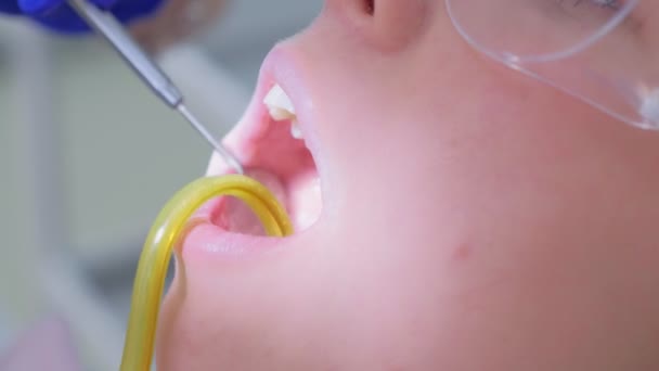 Limpieza del dentista cepillado y pulido de los dientes de las mujeres utiliza taladro, vista de cerca . — Vídeos de Stock