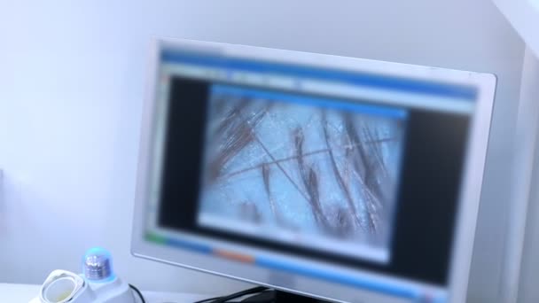 Trichoskopie am Monitor in der Klinik, Haare auf der Kopfhaut Nahaufnahme. — Stockvideo