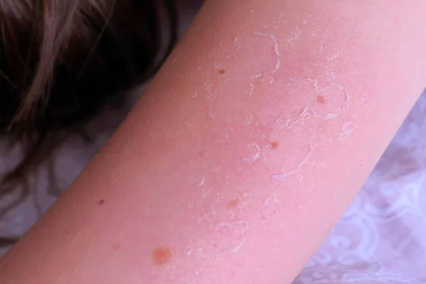 Closeup view of burnt peeling skin from UV sunburn on hand, closeup view. — Stock Photo, Image