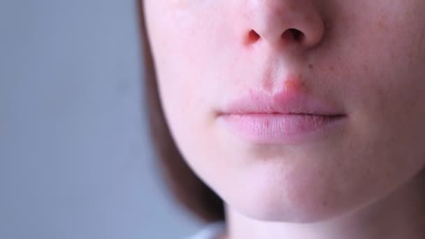 Herpesvirus op menselijke lippen. vrouw met herpes zere op lip mond, close-up uitzicht. — Stockvideo