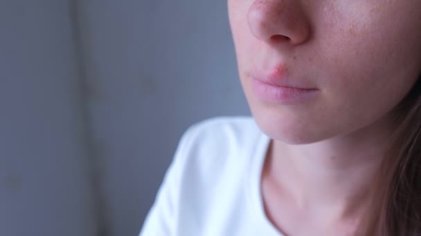 Herpes virus on human lips. Woman with herpes sore on lip mouth, closeup view. — 비디오