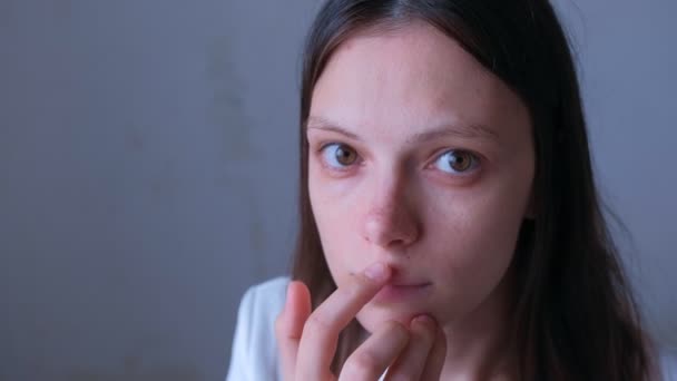 Portret van de vrouw smeert haar zere lip met zalf van herpes infectie. — Stockvideo