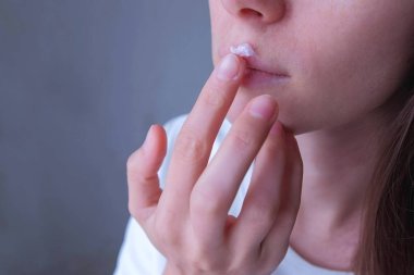 Kadın üst dudağına uçuk enfeksiyonundan kaynaklanan merhem sürüyor..