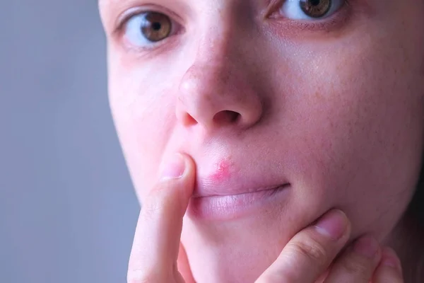 Herpes virus on human lips. Woman with herpes sore on upper lip on mouth.