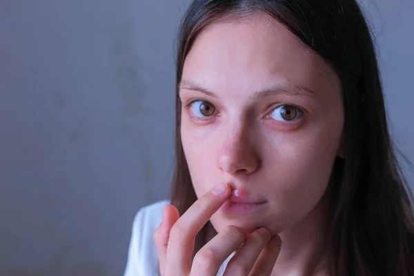 Retrato de mulher esfrega sua ferida no lábio com pomada de infecção por herpes . — Fotografia de Stock