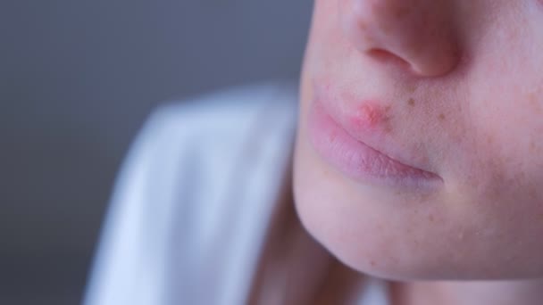 Herpesvirus på läpparna. Kvinna med herpes öm på läppen mun, närbild. — Stockvideo