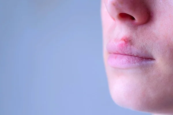 Вирус герпеса на губах. Женщина с герпесом во рту, вид крупным планом . — стоковое фото